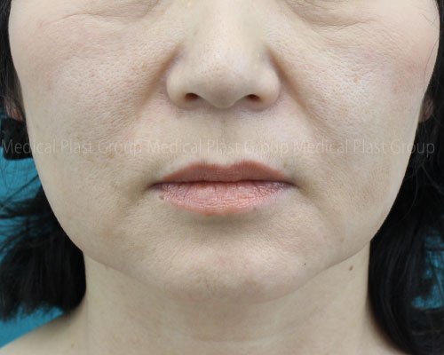 Bnls注射と輪郭注射は顔のたるみもとれるか ５０代モニター様で検証 美容医療を愛してやまないプラストクリニック 東京 のスタッフブログ