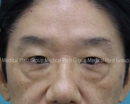 重度の目の下たるみ 膨らみを切らずに治した男性 ６か月間の症例紹介５０代 美容医療を愛してやまないプラストクリニック 東京 のスタッフブログ