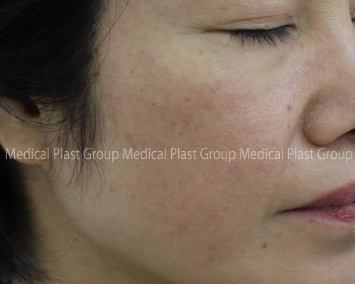 たくさんある盛り上がった茶色いシミ 老人性イボ 脂漏性角化症 を取った症例紹介 お顔編 お胸編 美容医療を愛してやまないプラストクリニック 東京 のスタッフブログ