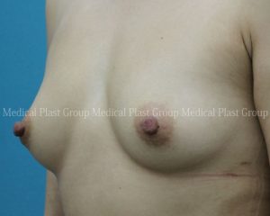 巨大乳首　女　拡大 東京形成美容外科