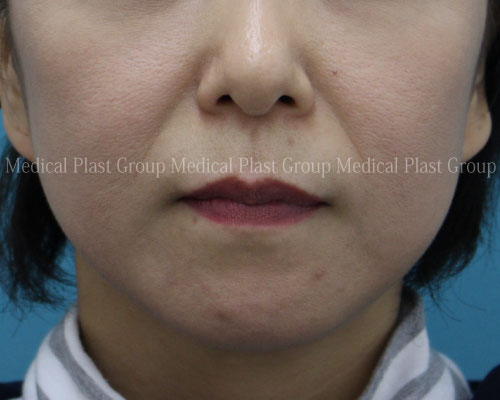 ほうれい線の永続的治療 鼻翼基部 びよくきぶ プロテーゼの手術風景と効果 リスク 費用 適用について 美容医療を愛してやまないプラストクリニック 東京 のスタッフブログ