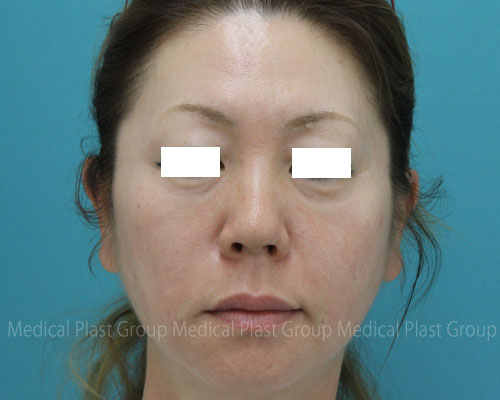 40代で失敗しないヒアルロン酸の秘訣は 美容医療を愛してやまないプラストクリニック 東京 のスタッフブログ