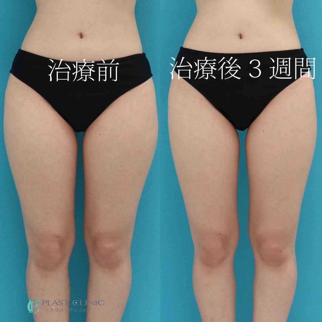 リポセルで脚痩せ♡どのくらい細くなるの？ 【プラストクリニック東京